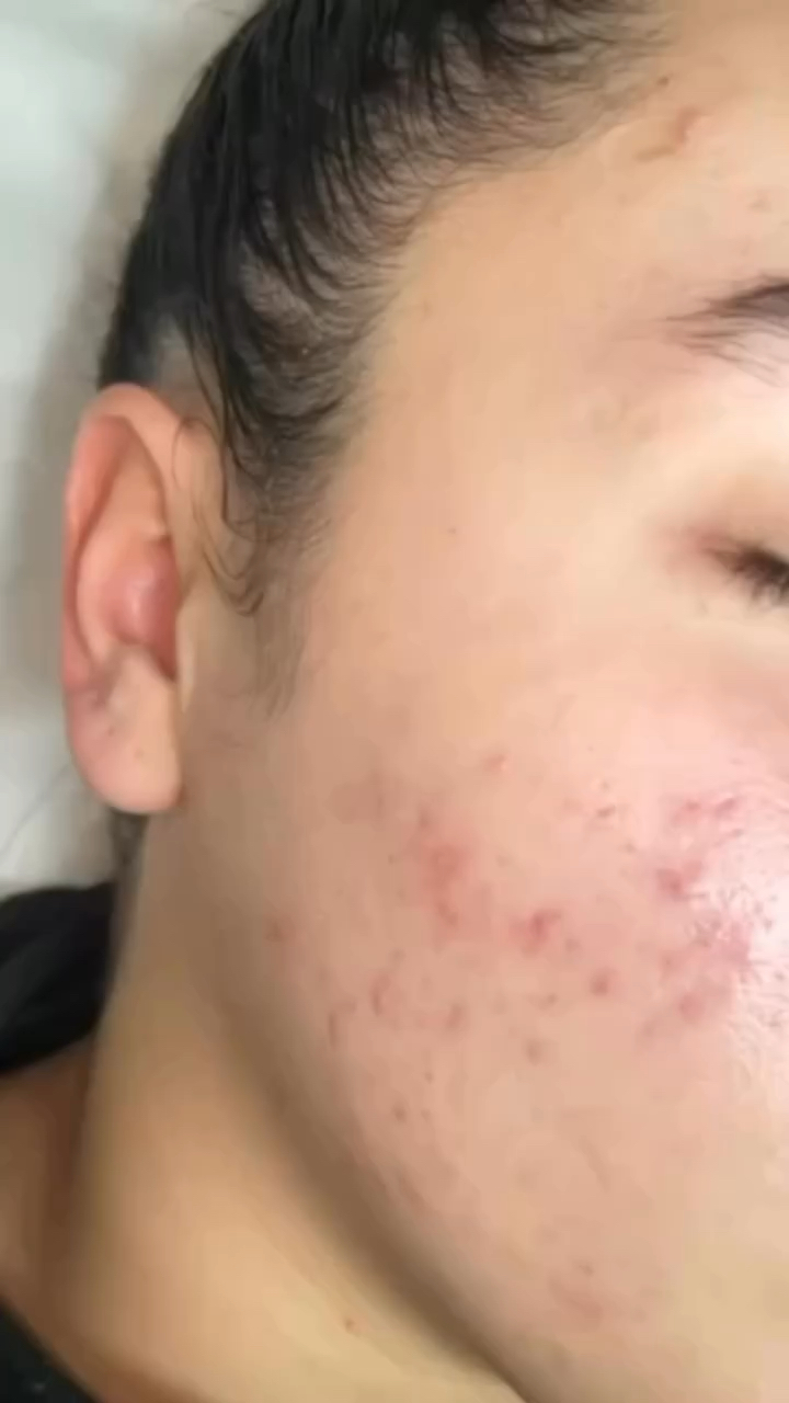 Vidéo Coral Sea Peel ,si besoin extraction supplément 32e chez LIYAH PARIS