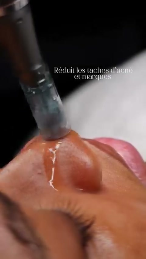 Vidéo Micro-Peel chez Boole Paris