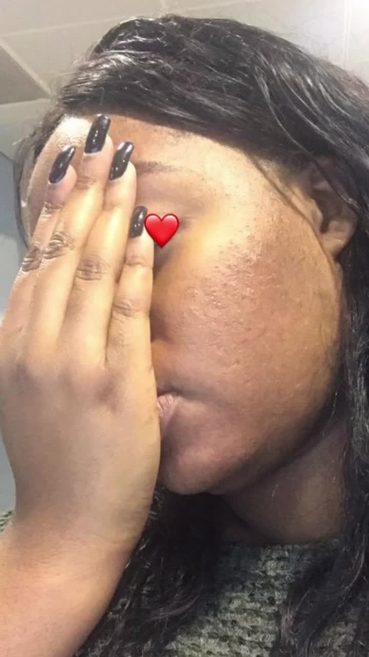 Vidéo Peeling supreme 30 % ,si besoin extraction supplément 32 euro chez LIYAH PARIS