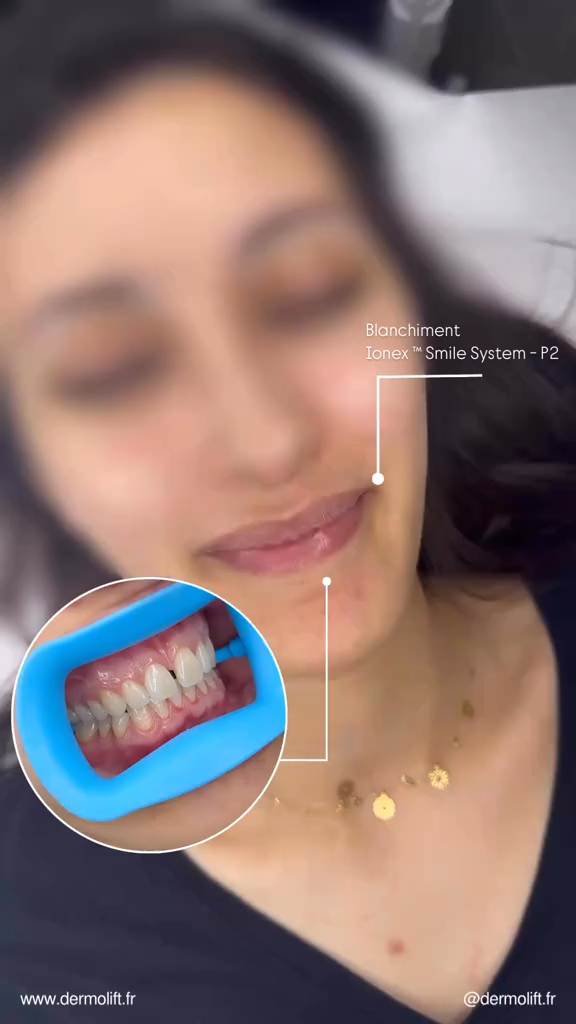 Vidéo Joues chez DERMOLIFT X 8BEAUTY