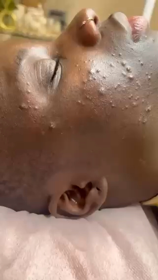 Vidéo Coral Sea Peel ,si besoin extraction supplément 32e chez LIYAH PARIS