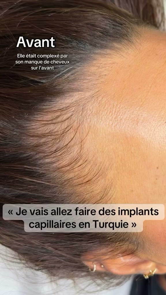 Vidéo Tricopigmentation poil À POIL chez Ines Beauty