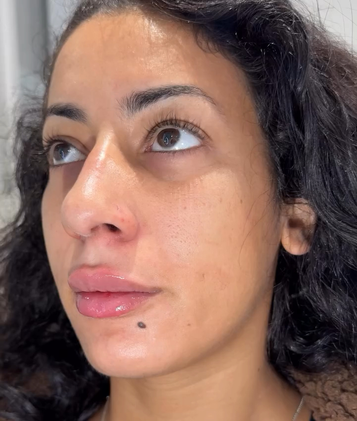 Vidéo 𝐑𝐄𝐕𝐈𝐓𝐀𝐋𝐈𝐒𝐀𝐓𝐈𝐎𝐍 𝐃𝐄𝐒 𝐋𝐄𝐕𝐑𝐄𝐒 À 𝐋'𝐀𝐂𝐈𝐃𝐄 𝐇𝐘𝐀𝐋𝐔𝐑𝐎𝐍𝐈𝐐𝐔𝐄- Effets Durable 10 mois ⭐️⭐️⭐️⭐️⭐️ chez CASA DE LA BEAUTÉ