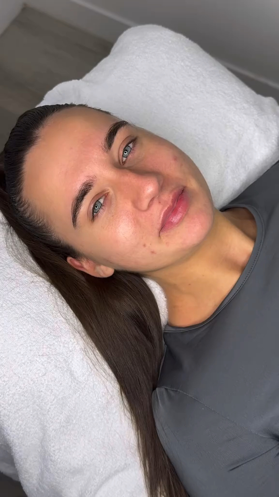 Vidéo Joues chez DERMOLIFT X 8BEAUTY