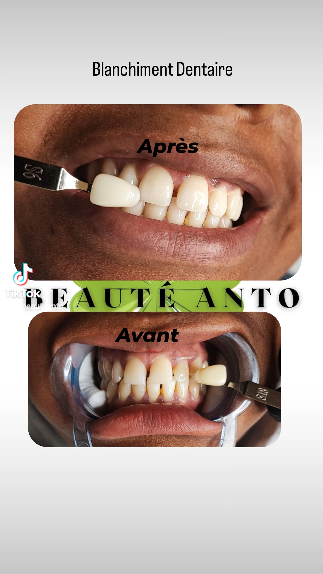 Vidéo Blanchiment dentaire chez Beaute Anto