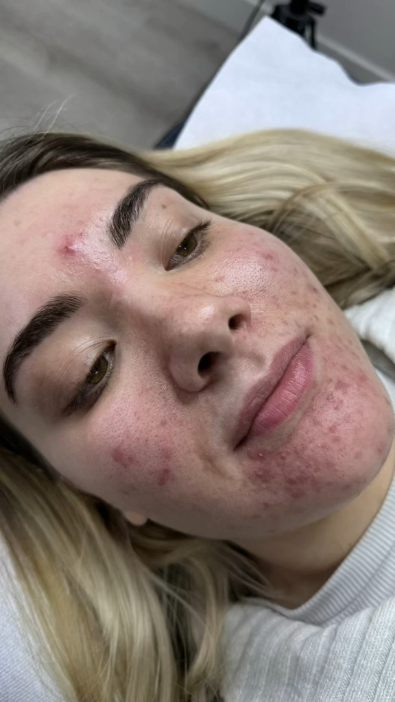 Vidéo Joues chez DERMOLIFT X 8BEAUTY