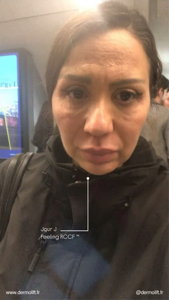 Vidéo Joues chez DERMOLIFT X 8BEAUTY