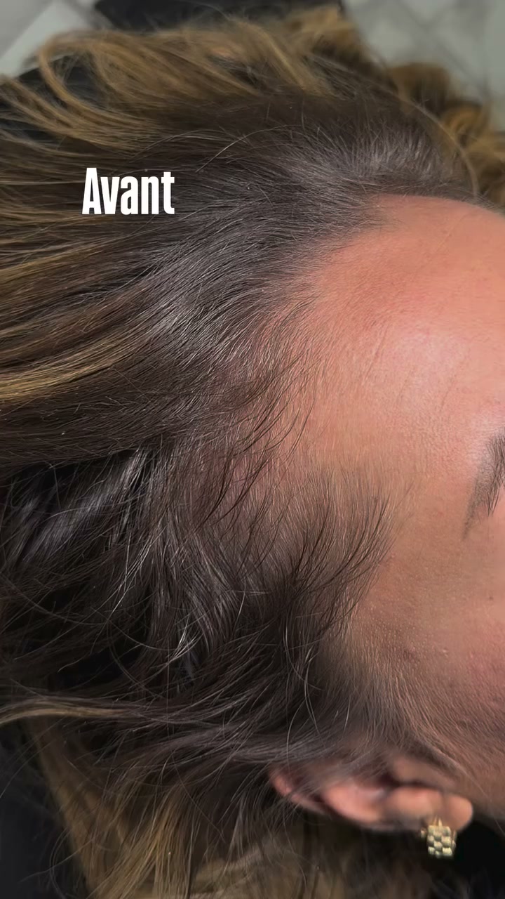 Vidéo Tricopigmentation poil À POIL chez Ines Beauty